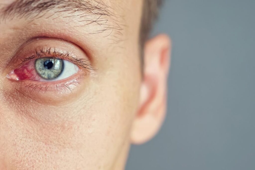 Close up shot of a person's alcoholic eyes